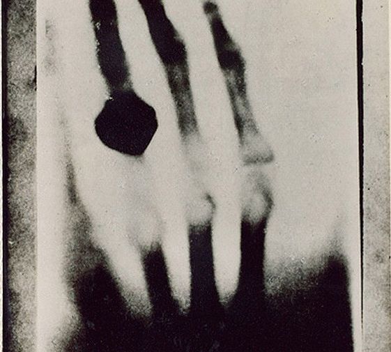 Снимок руки жены ученого — Берты Рентген, сделанный 22 декабря 1895 года